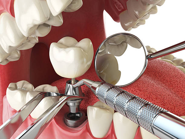 Best Emergency Treatment for Oral Infections in Kingston, WA